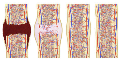 Fracture healing for super-inductive-system.com