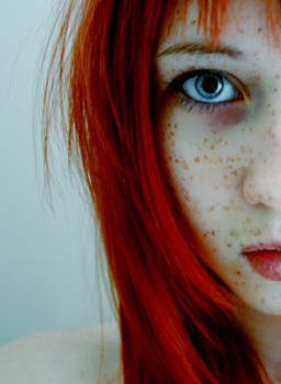 freckles