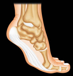 plantar fasciitis