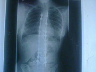 Scoliosis Surgery X-Ray