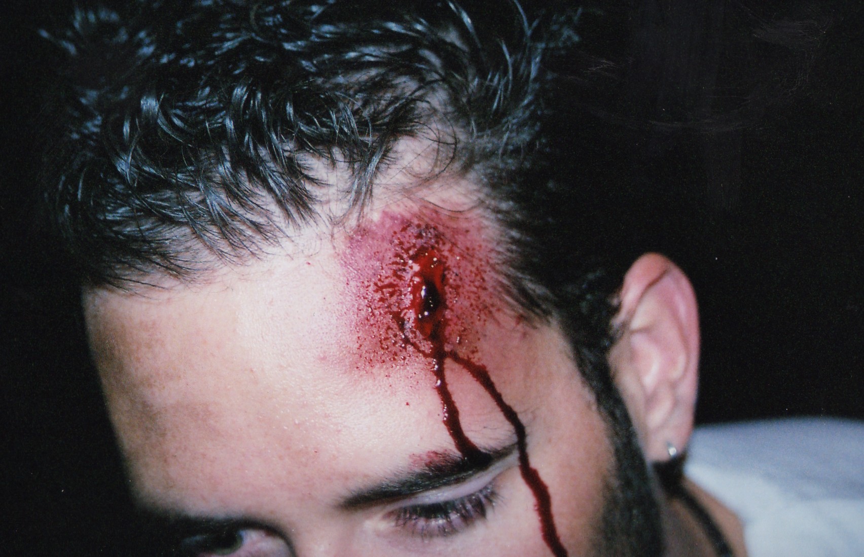 'Jared's' head wound pre-blood