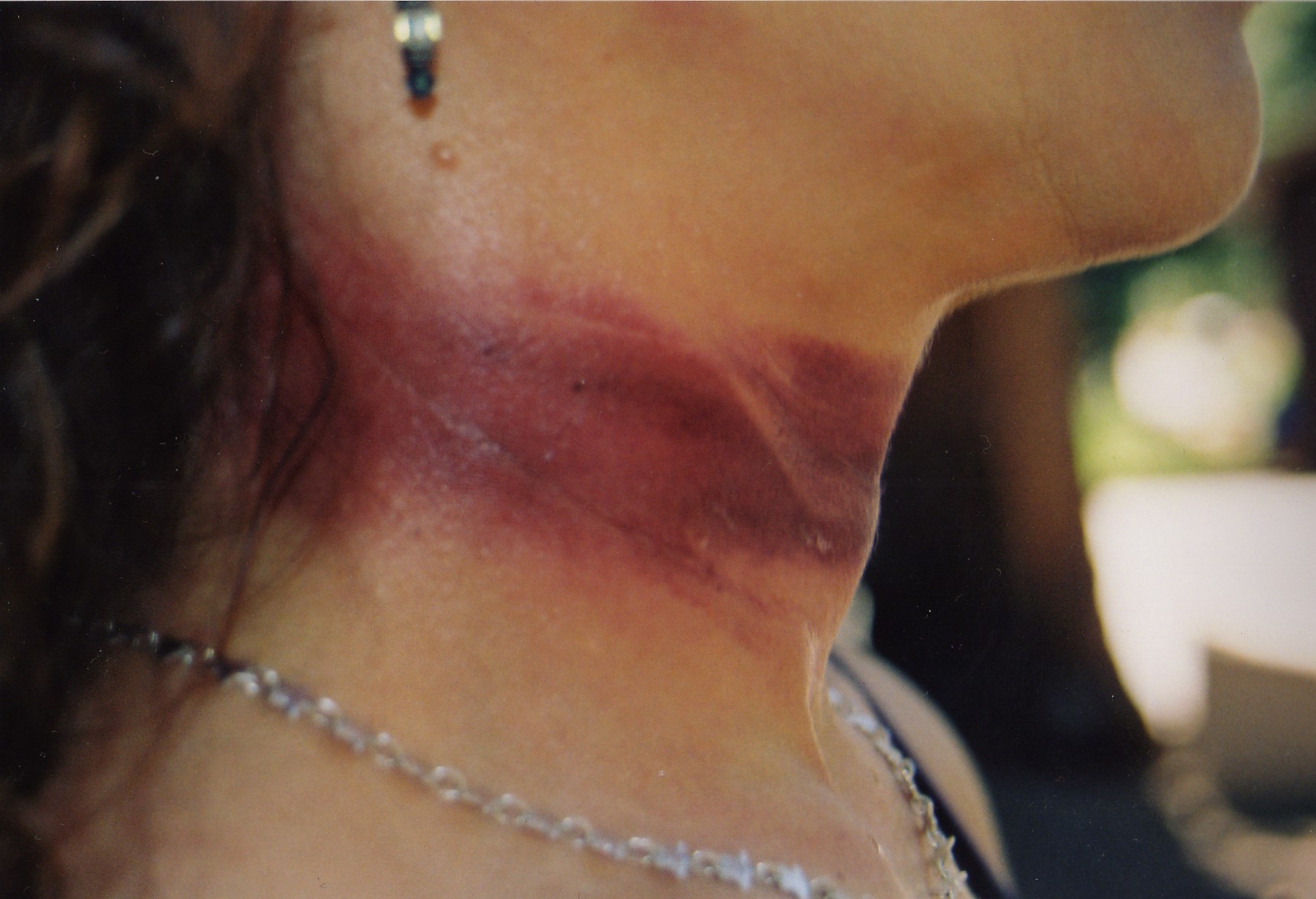 Kit S Ligature Marks By Bathory Babe On Deviantart