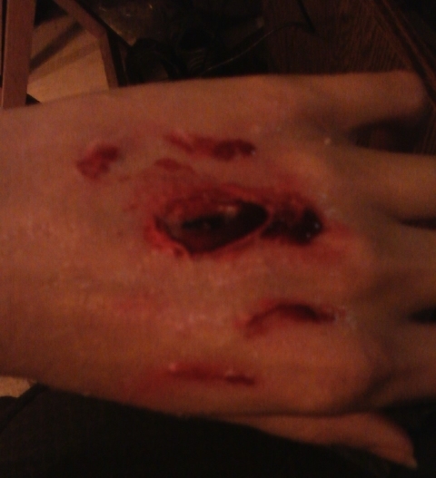 Wound attempt 2