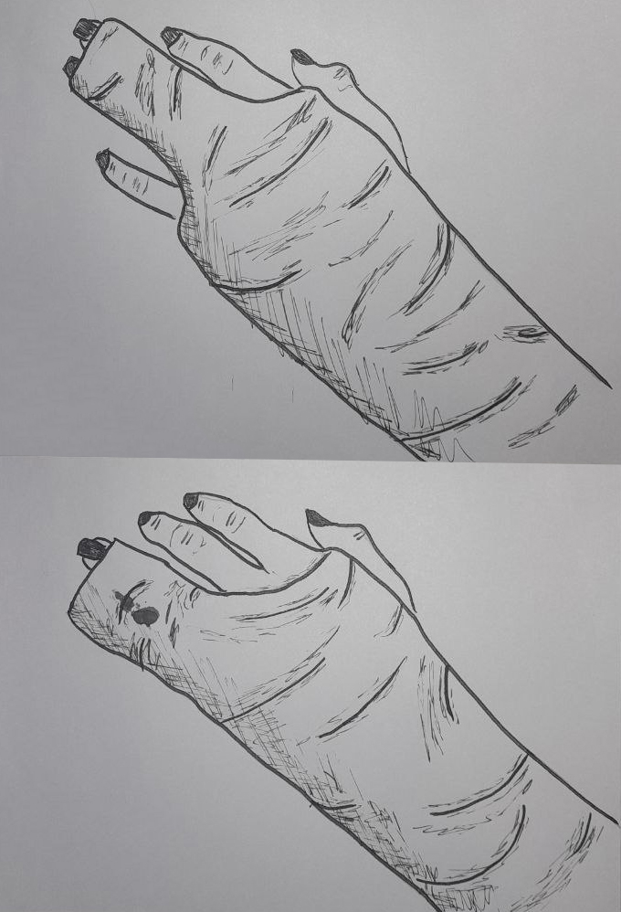 Spring Loaded Serial Cast Finger Finger cast variations by Betty-Candy on DeviantArt