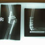 my broken arm