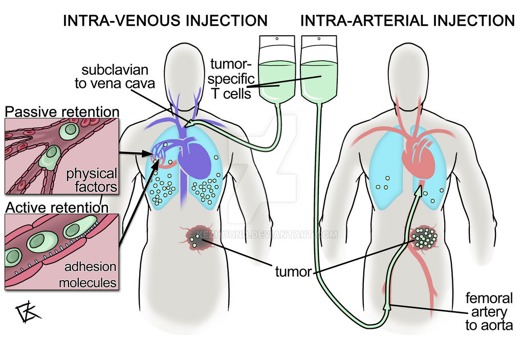 Atrail Inj Intra-arterial immunotherapy by Kezhound on DeviantArt