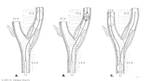 Vessel Plaque Surgery Techniques by LeccathuFurvicael