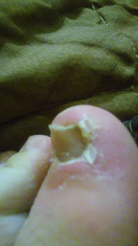 So I Did This To My Toe