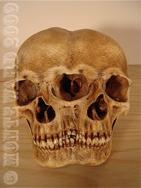 Conjoined Human Skull