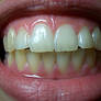 Teeth II