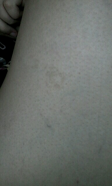 Birthmark That Looks Like A Bruise