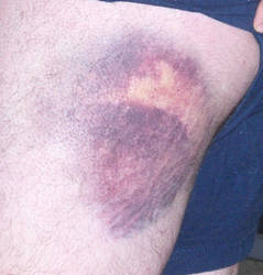 Big Bruise