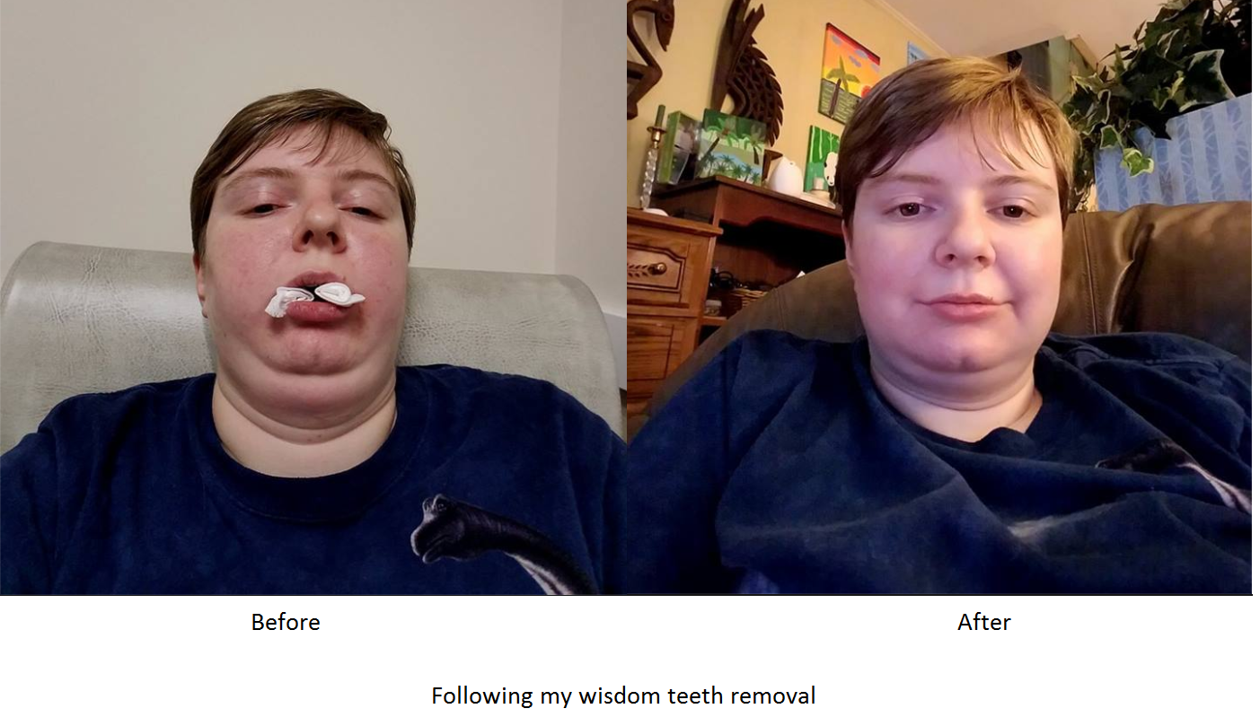 wisdom teeth before and after