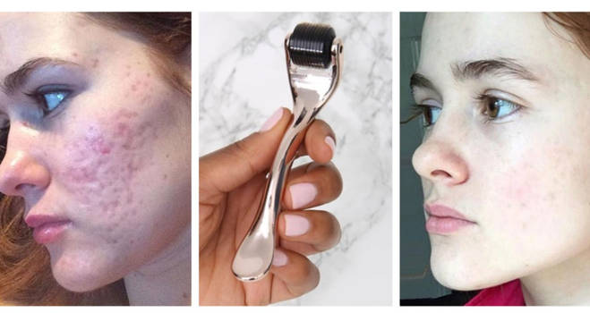 Dermaroller for Acne Scars