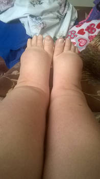 My Swollen Feet