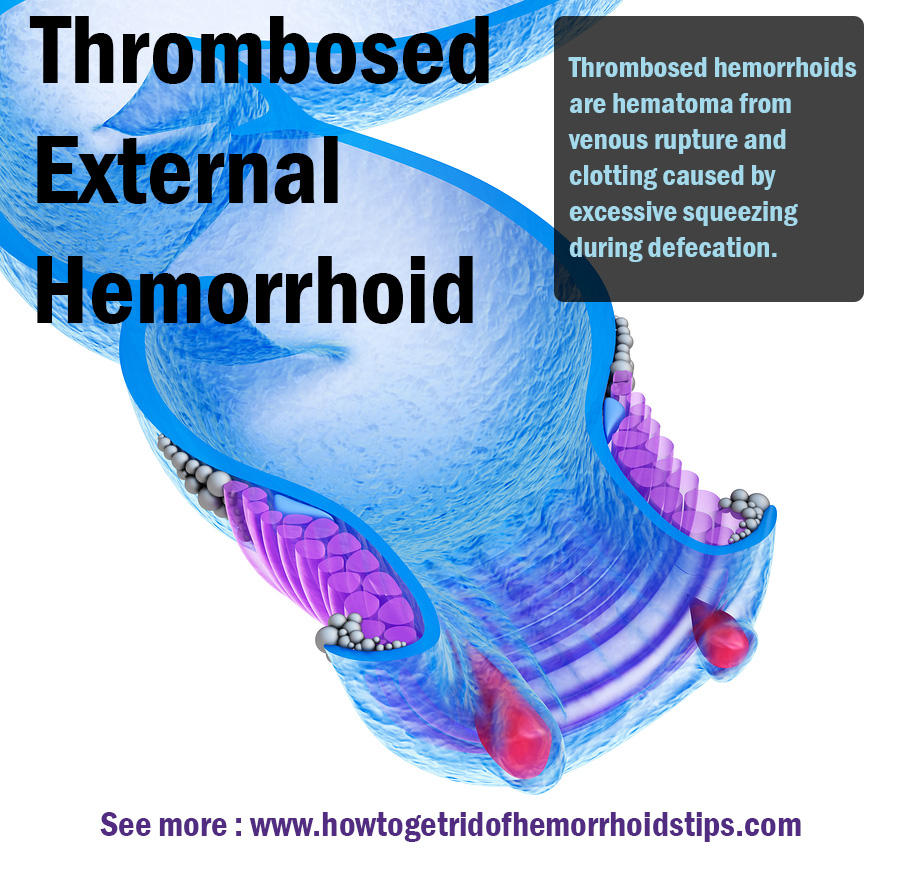 Thrombosed external hemorrhoid by carehemorrhoids on DeviantArt