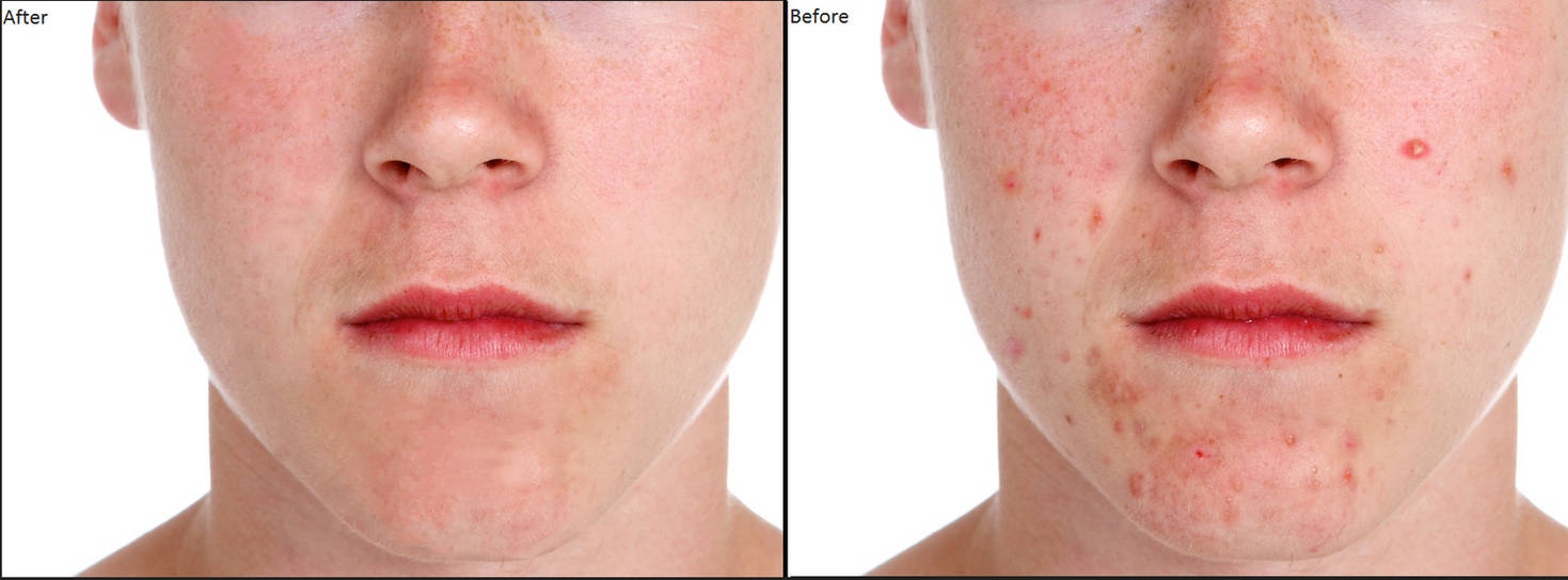 Acne Photoshop by williamRehndell on DeviantArt