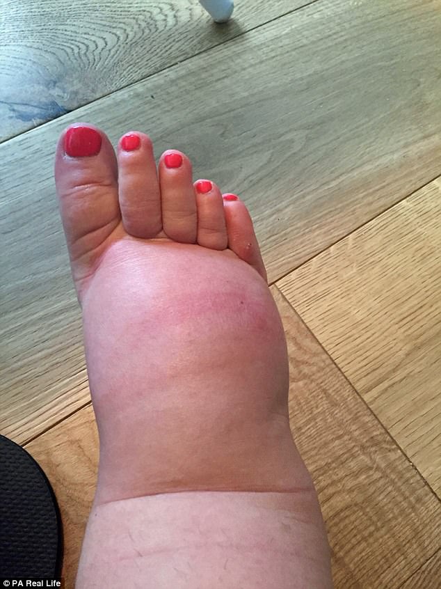 Super Swollen Fat Foot by KungFlew2013 on DeviantArt