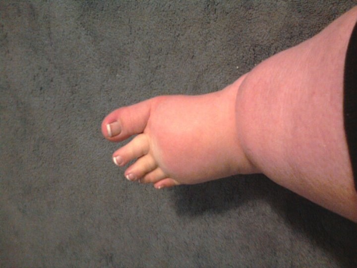 Super Fat Foot And Cankle by KungFlew2013 on DeviantArt