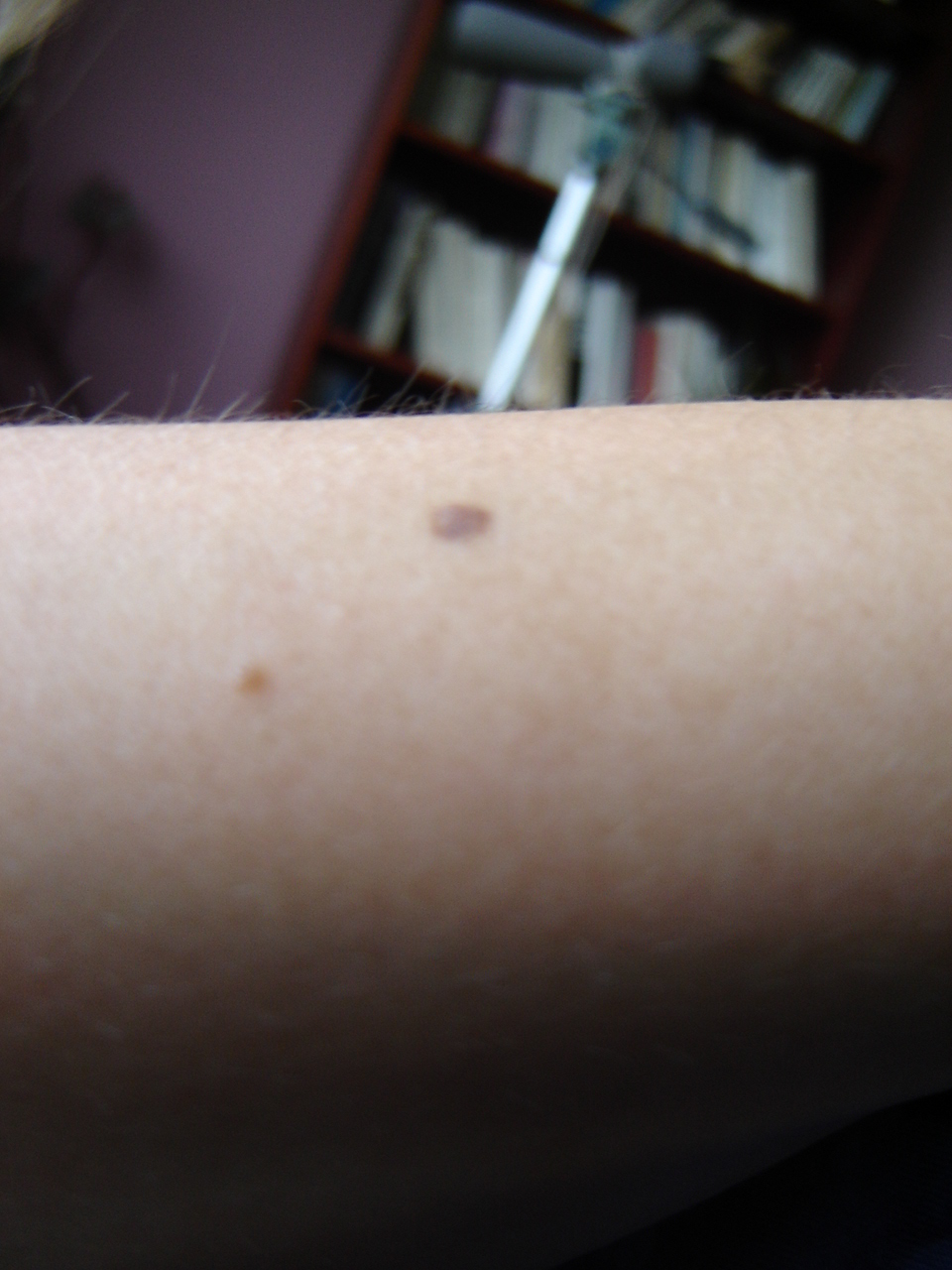 Spots on arm