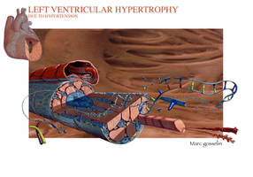LV Hypertrophy