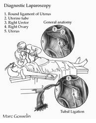 Laparoscopy by marcgosselin