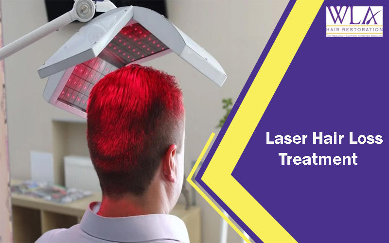 Laser Hair Loss Treatment Los Angeles by hairerswla on DeviantArt