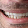 Dentales implantes de dientes: proceso paso a paso