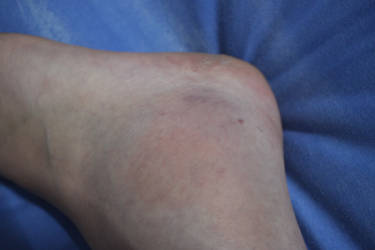 The Resulting Bruise