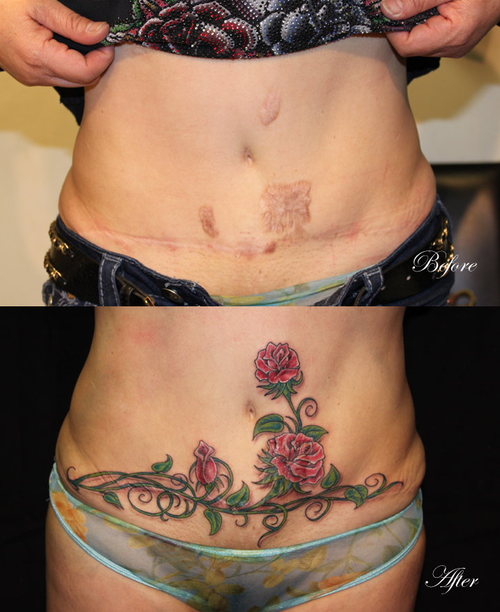 Surgical Scar Coverup Tattoo