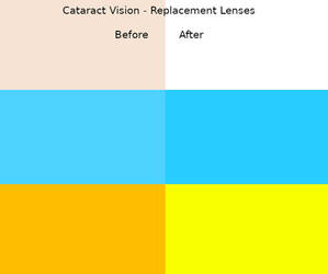 Cataract Vision