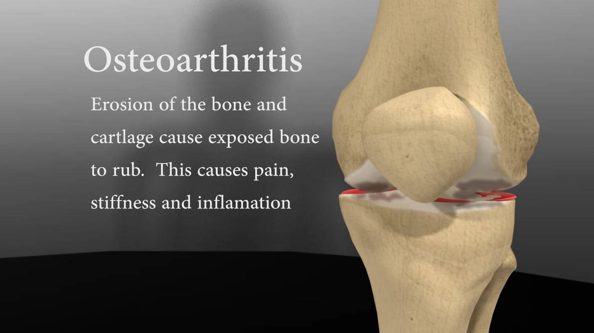 Osteoarthritis by ichiwings on DeviantArt