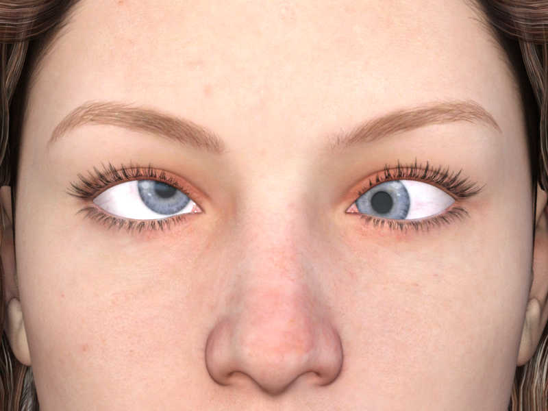 Lazy eye