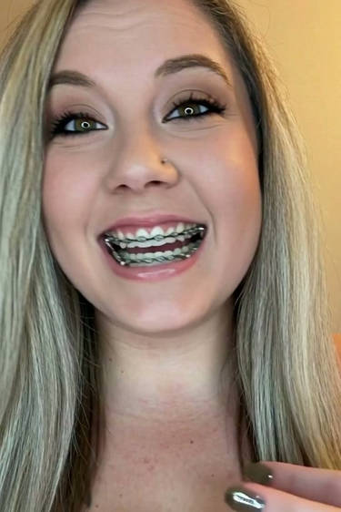 Braces herbst