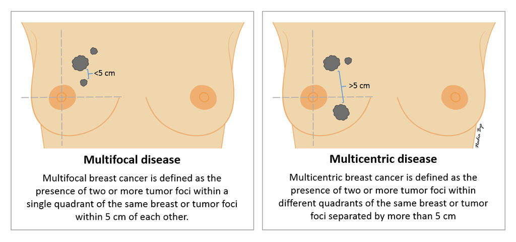 multifocal versus multicentric breast Asian gangbang old men blindfold