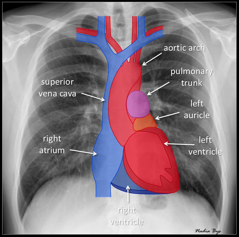 How To Interpret A Chest X Ray Lesson 5 Cardiac Silho vrogue.co