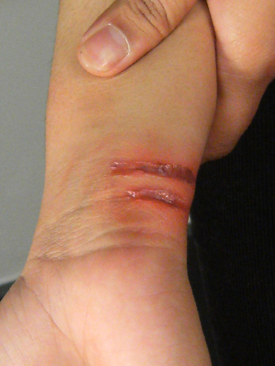 Oven Element Burn SFX Make-Up by punkd-pyroshadow