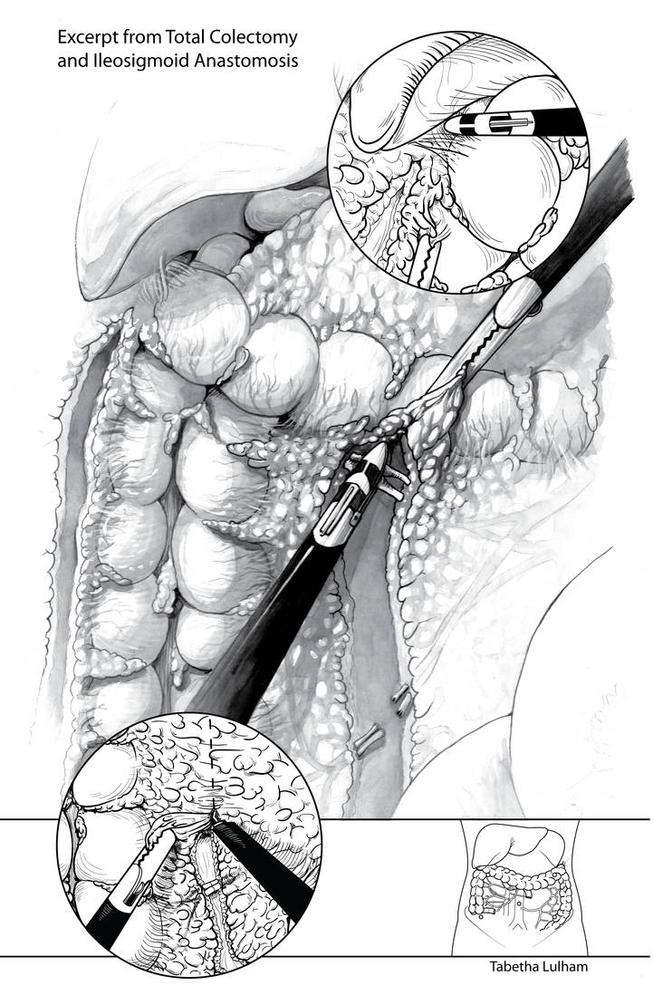 BMC - Surgical Illustration by Strayfish