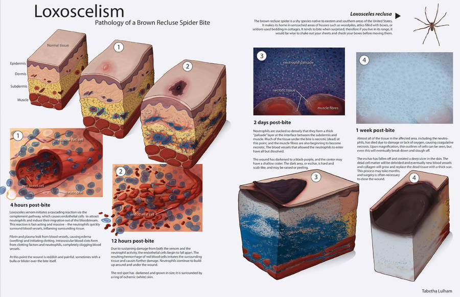Loxoscelism - Pathology by Strayfish